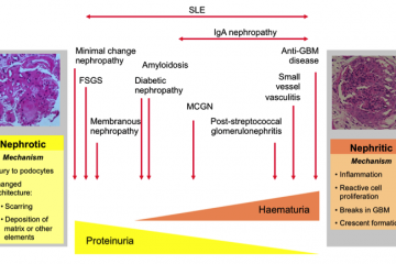Shows types of nephritis on a spectrum